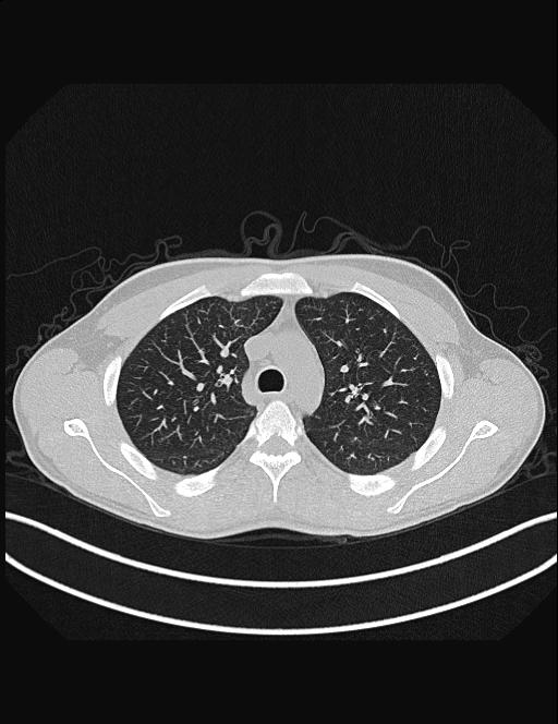 Calcifying pulmonary metastases (Radiopaedia 33359-34396 Axial lung window 19).jpg