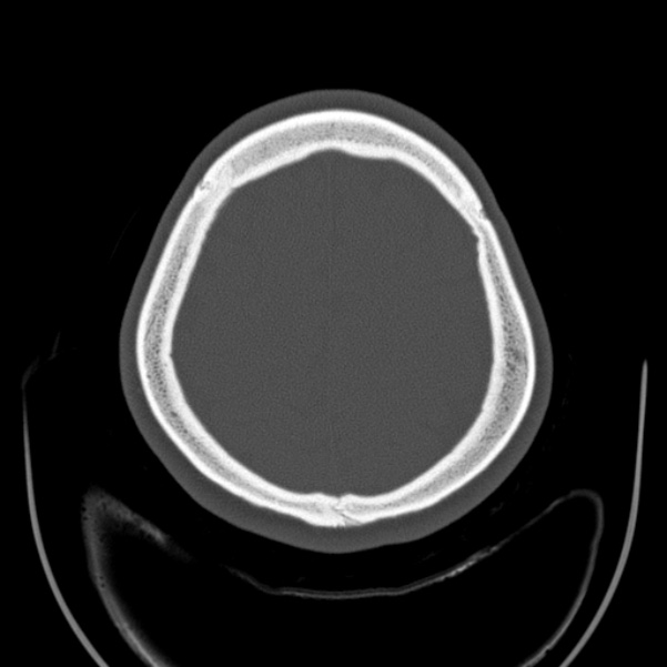 Calvarial osteoma (Radiopaedia 36520-38079 Axial bone window 88).jpg