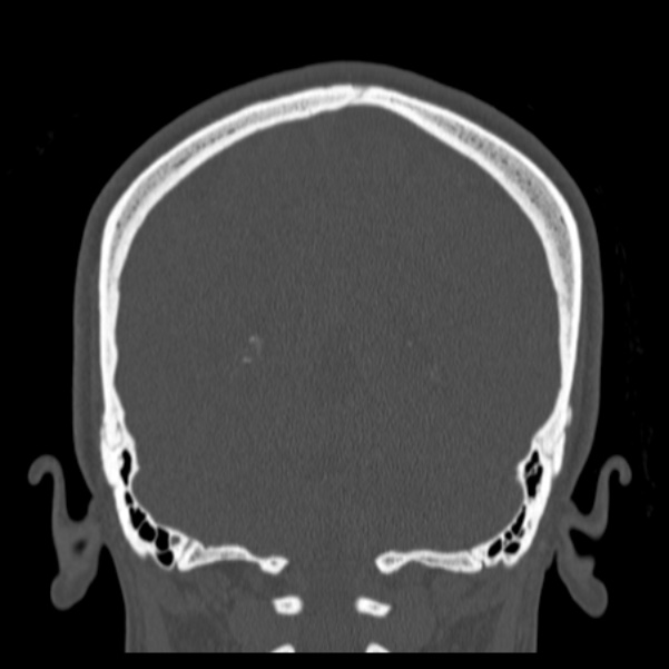 Calvarial osteoma (Radiopaedia 36520-38079 C 67).jpg