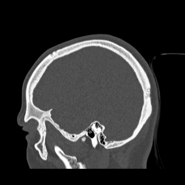 Calvarial osteoma (Radiopaedia 36520-38079 Sagittal bone window 27).jpg