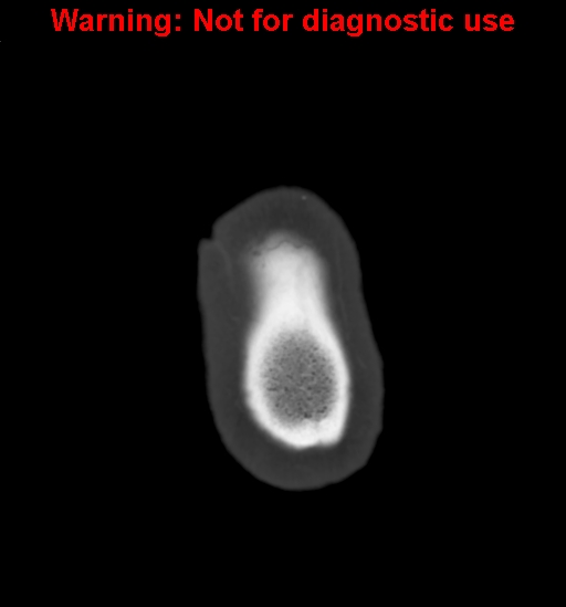 Calvarial thickening from chronic shunting (Radiopaedia 60079-67637 Axial bone window 186).jpg