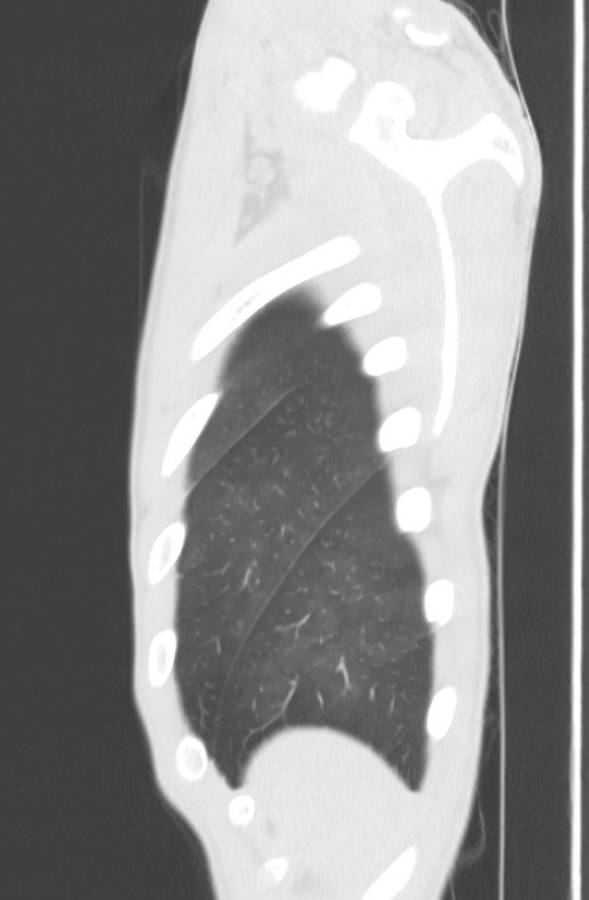 Cannabis-induced diffuse alveolar hemorrhage (Radiopaedia 89834-106946 Sagittal lung window 131).jpg