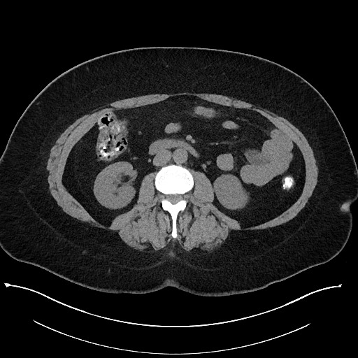 File:Carcinoid tumor - terminal ileum (Radiopaedia 60931-68740 Axial non-contrast 54).jpg