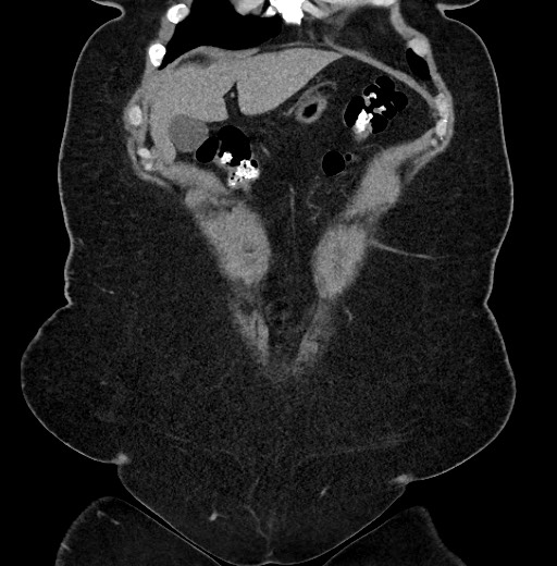 Carcinoid tumor - terminal ileum (Radiopaedia 60931-68740 Coronal non-contrast 13).jpg