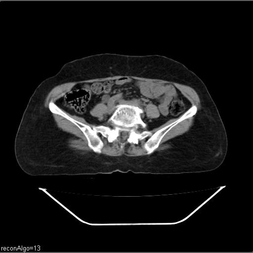 File:Carcinoma cervix- recurrence (Radiopaedia 34702-36137 Axial non-contrast 35).jpg
