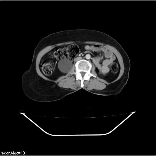 File:Carcinoma cervix- recurrence (Radiopaedia 34702-36137 B 27).jpg