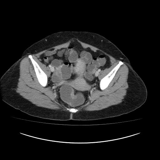 File:Carcinoma colon - hepatic flexure (Radiopaedia 19461-19493 A 111).jpg