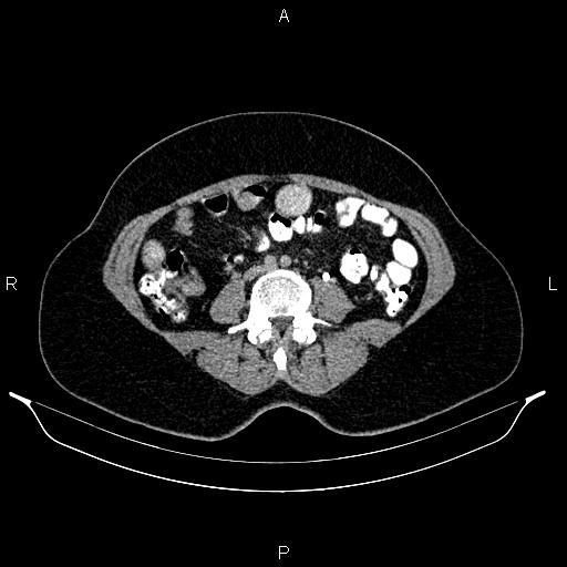 File:Carcinoma of uterine cervix (Radiopaedia 85861-101700 Axial C+ delayed 48).jpg