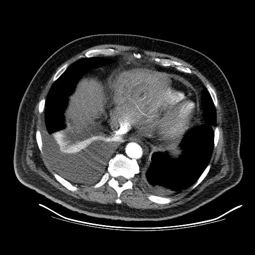 File:Cardiac lymphoma (Radiopaedia 38690-40836 Axial C+ CTPA 17).jpg