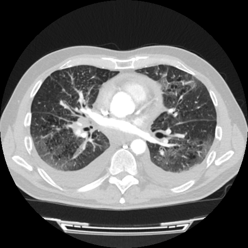 Cardiac tamponade (Radiopaedia 78607-91368 Axial lung window 46).jpg