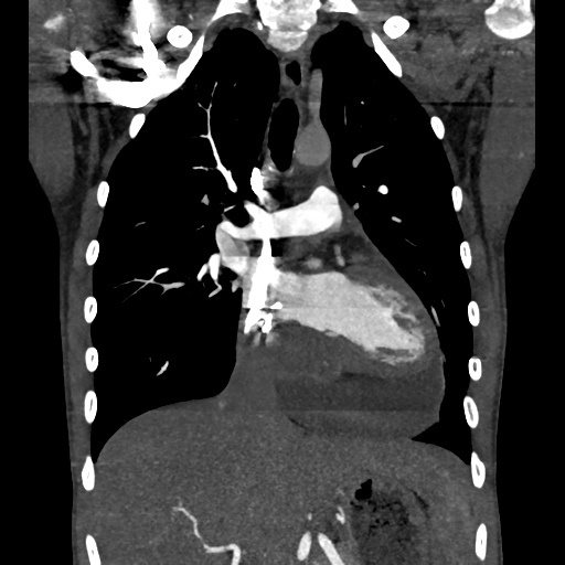 Cardiac tumor - undifferentiated pleomorphic sarcoma (Radiopaedia 45844-50134 Coronal non-contrast 31).png