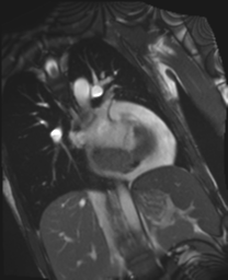 File:Cardiac tumor - undifferentiated pleomorphic sarcoma (Radiopaedia 45844-50136 Oblique T2 5).png