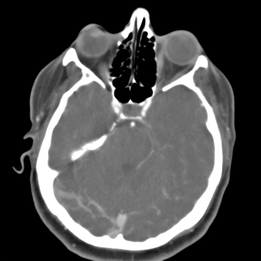Carotico ophthalmic aneurysm (Radiopaedia 42916-46148 A 37).png