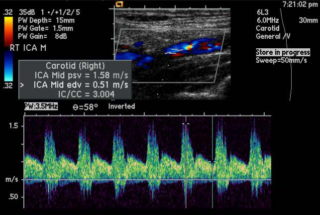 File:Carotid artery stenosis (Radiopaedia 11280-11644 B 1).jpg