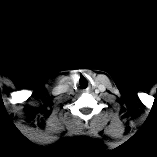 File:Carotid body tumor (Radiopaedia 27890-28124 A 22).jpg
