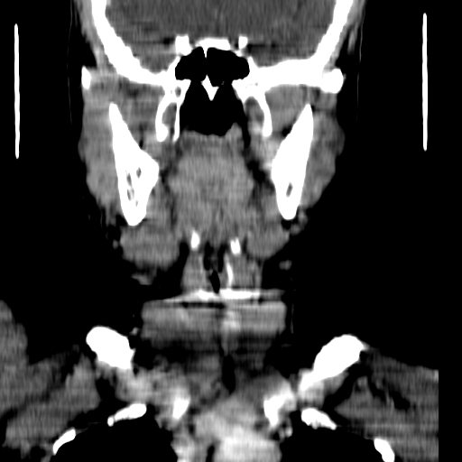 File:Carotid body tumor (Radiopaedia 27890-28124 B 14).jpg