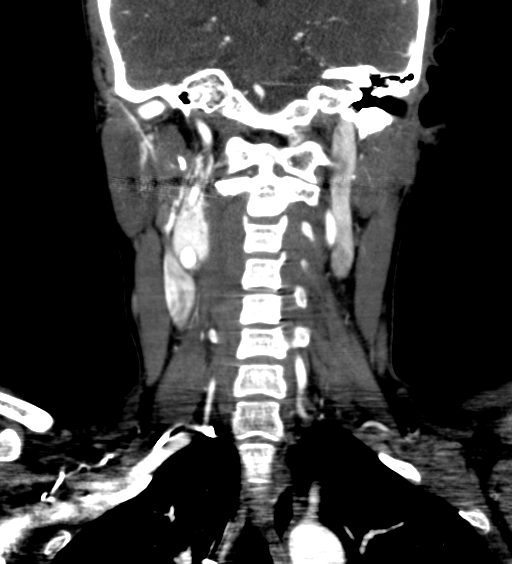 File:Carotid body tumor (Radiopaedia 39845-42300 C 53).jpg