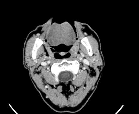 File:Carotid body tumor (Radiopaedia 61750-69757 Axial Post contrast 23).jpg