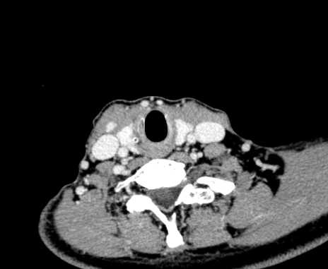 Carotid body tumor (Radiopaedia 61750-69757 Axial Post contrast 92).jpg