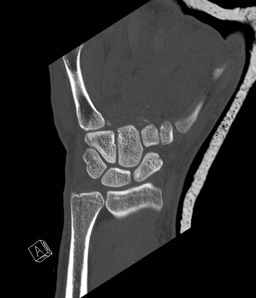 File:Carpal fractures (smart watch impaction) (Radiopaedia 55844-62430 Coronal bone window 13).jpg