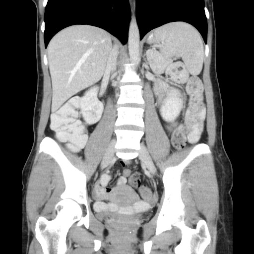 Castleman disease with fibrous pseudotumor in the abdomen (Radiopaedia 77296-89373 B 54).jpg