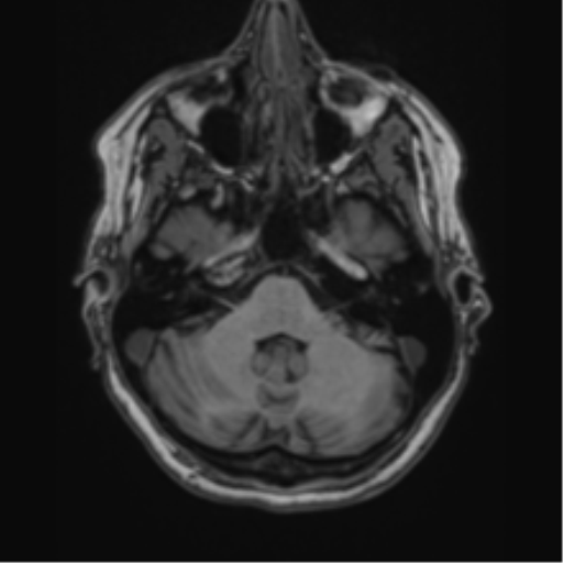 File:Cavernoma with bleed - midbrain (Radiopaedia 54546-60774 Axial T1 1).png
