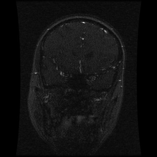 Cavernoma with developmental venous anomaly (Radiopaedia 22470-22507 MRV 89).jpg