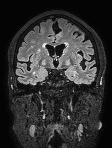 Cavernous hemangioma of the cerebellar falx (Radiopaedia 73025-83724 Coronal FLAIR 160).jpg