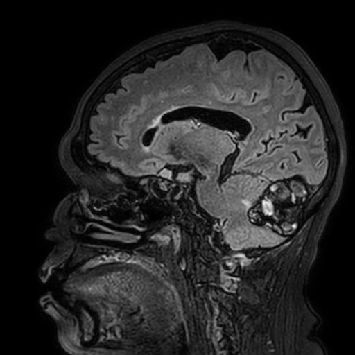 File:Cavernous hemangioma of the cerebellar falx (Radiopaedia 73025-83724 Sagittal FLAIR 130).jpg