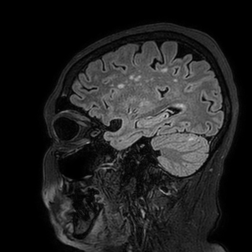 Cavernous hemangioma of the cerebellar falx (Radiopaedia 73025-83724 Sagittal FLAIR 55).jpg