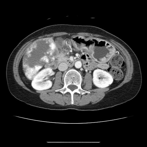 Cavernous hepatic hemangioma (Radiopaedia 75441-86667 B 54).jpg