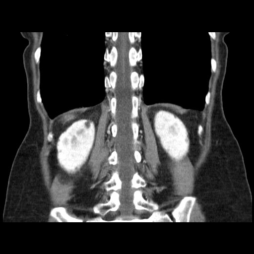 Cavernous hepatic hemangioma (Radiopaedia 75441-86667 C 112).jpg