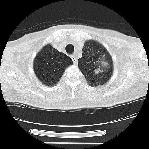File:Cavitating pulmonary metastases (Radiopaedia 89545-106544 Axial lung window 9).jpg