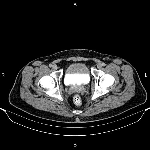 Cecal adenocarcinoma (Radiopaedia 85324-100916 Axial C+ delayed 96).jpg