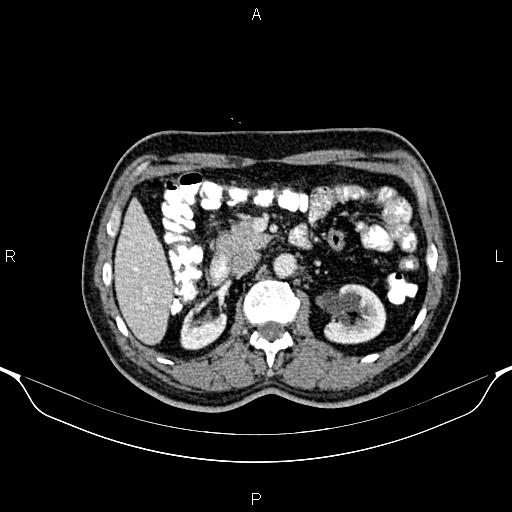 Cecal adenocarcinoma (Radiopaedia 85324-100916 B 36).jpg
