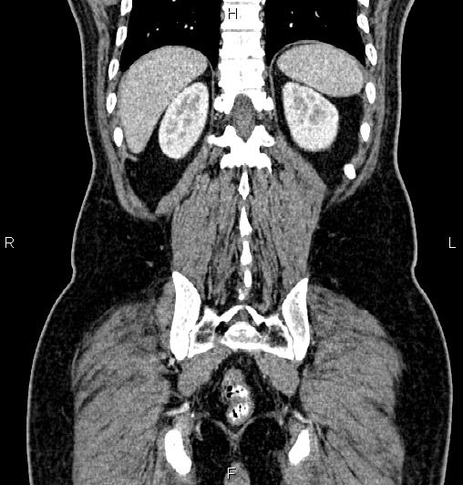 Cecal adenocarcinoma (Radiopaedia 85324-100916 D 55).jpg