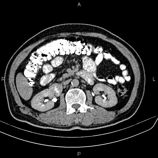 File:Cecal cancer with appendiceal mucocele (Radiopaedia 91080-108651 Axial C+ delayed 25).jpg