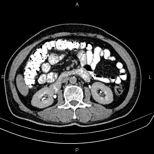 File:Cecal cancer with appendiceal mucocele (Radiopaedia 91080-108651 Axial C+ delayed 27).jpg