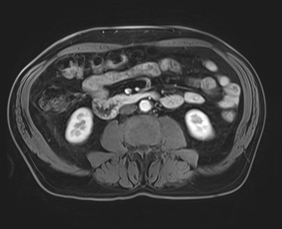 Cecal mass causing appendicitis (Radiopaedia 59207-66532 H 74).jpg