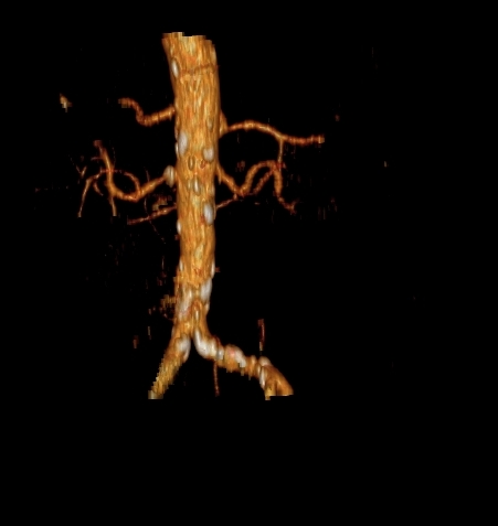 File:Celiacomesenteric trunk (Radiopaedia 67660-77071 VR C+ arterial phase 16).jpg
