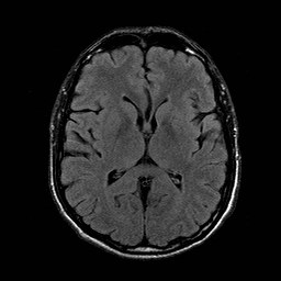 File:Central-variant posterior reversible encephalopathy syndrome (PRES) (Radiopaedia 43880-47359 Axial FLAIR 12).jpg