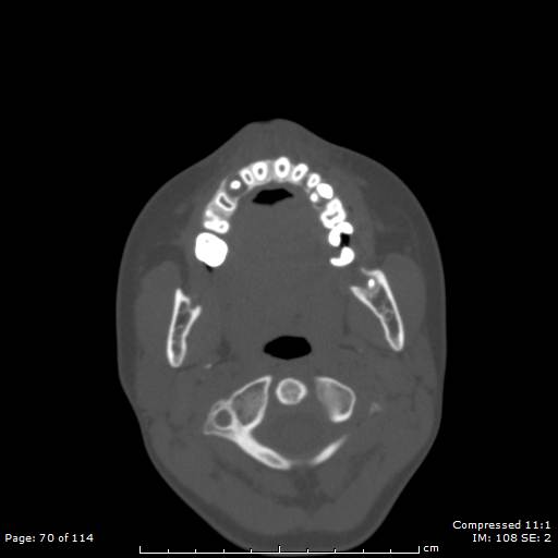 File:Central giant cell granuloma (Radiopaedia 45612-49754 Axial bone window 35).jpg