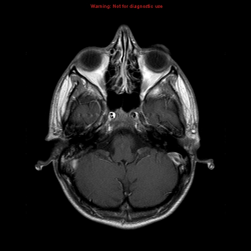 File:Central nervous system vasculitis (Radiopaedia 8410-9235 Axial T1 C+ 5).jpg