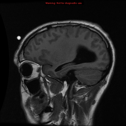 File:Central neurocytoma (Radiopaedia 13188-13206 Sagittal T1 15).jpg
