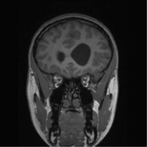 Central neurocytoma (Radiopaedia 37664-39557 Coronal T1 65).png