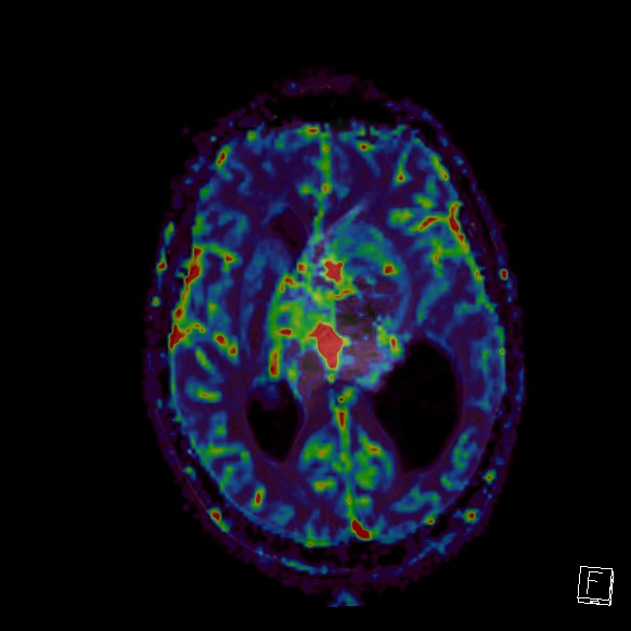 Central neurocytoma (Radiopaedia 84497-99872 Axial Perfusion 159).jpg