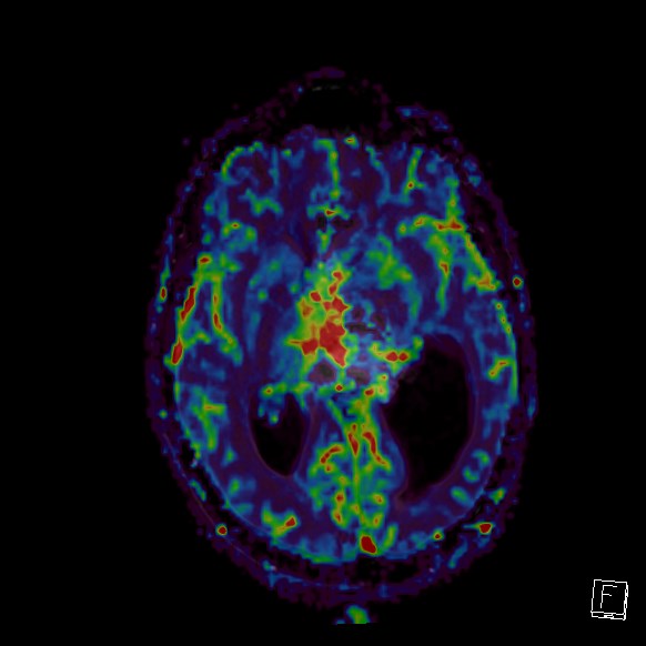 Central neurocytoma (Radiopaedia 84497-99872 Axial Perfusion 165).jpg