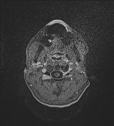 Central neurocytoma (Radiopaedia 84497-99872 Axial T1 C+ 3).jpg