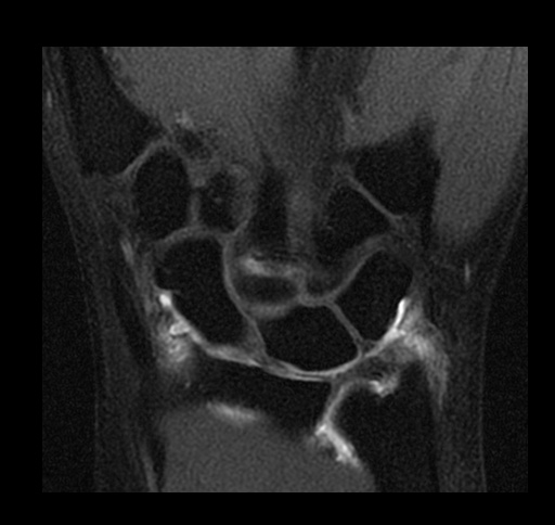 File:Central triangular fibrocartilage perforation (Radiopaedia 73346-84130 Coronal T1 fat sat 9).jpg