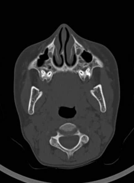 File:Cerebellar abscess (Radiopaedia 73727-84527 Axial bone window 10).jpg